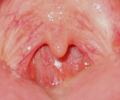 File:Uvula without tonsils.jpg