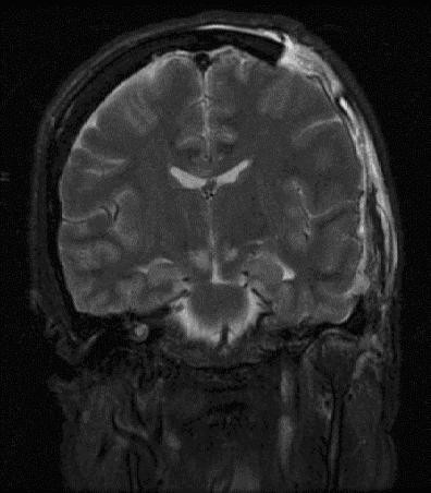 File:Brain herniation MRI.jpg