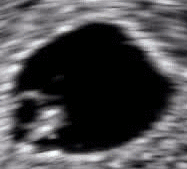 File:Embryo at 5 weeks 5 days with heartbeat.gif