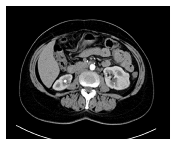 File:Preoperative-contrasted-CT-scans-of-the-patient-showing-multiple-bilateral-kidney-tumors-with-diameters-ranging-between.jpg