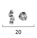R(20) - ring chromosome 20.PNG