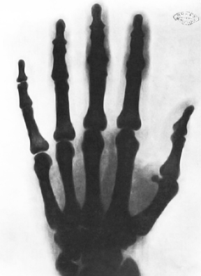 File:Рэнтгенаўскі здымак рукі Тэслы.jpeg