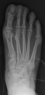 File:Stress fracture of the second metatarsal bone1.jpg