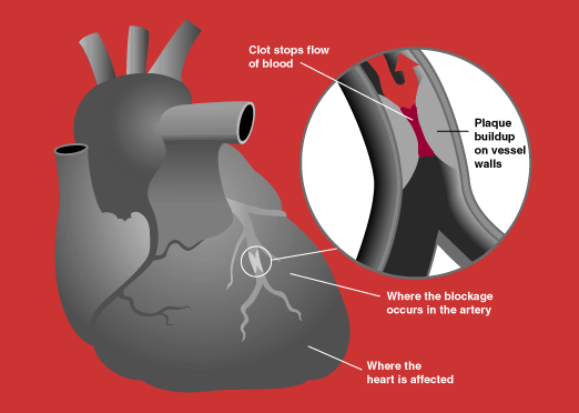 File:Heart attack diagram.png