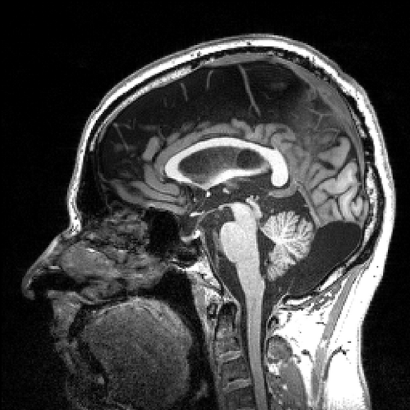 File:MRI EGC sagittal.png