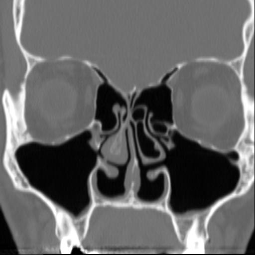 File:Empty-nose-after-80per-cent-partial-bilateral-turbinectomy.jpeg