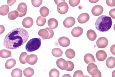 File:Neutrophil - Band cell-1 (+lymphocytes).JPG