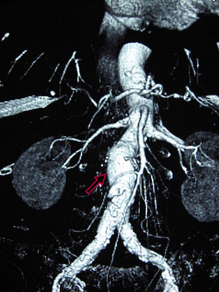 File:Abdominal aortic aneurysm.JPG