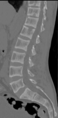 File:CT of rugger-jersey spine of renal osteodystrophy.jpg