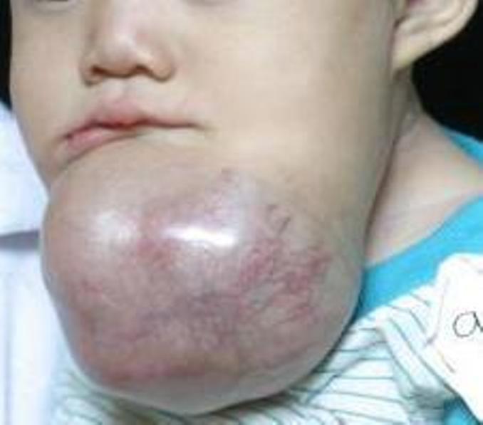 File:Ameloblastoma2.jpg
