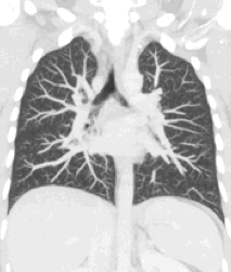 File:Coronal maximum intensity projection CT thorax.gif