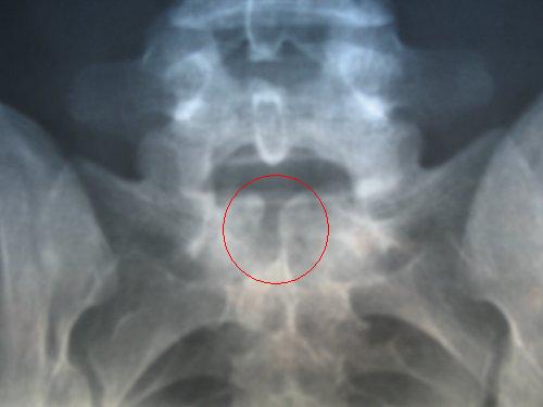 File:Spina Bifida pelvis X-ray.jpg