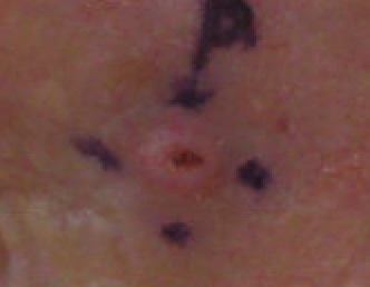 File:Squamous Cell Carcinoma Left Lateral Canthus.jpg
