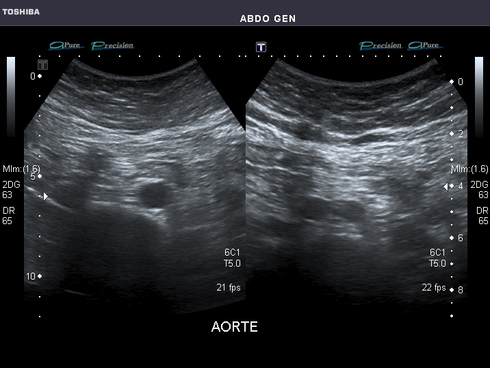 File:Abdominal Ultrasound Full Exam 44.jpg
