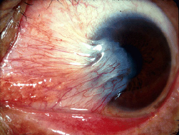 File:Pterygium (from Michigan Uni site, CC-BY).jpg