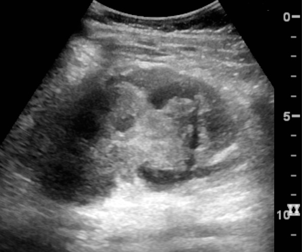 File:Ultrasonography of renal trauma with laceration.jpg