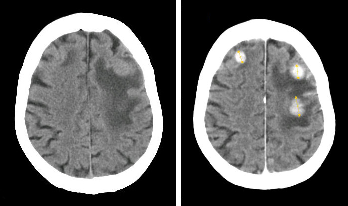 File:BrainMetastasisFromBreastCancer.jpg