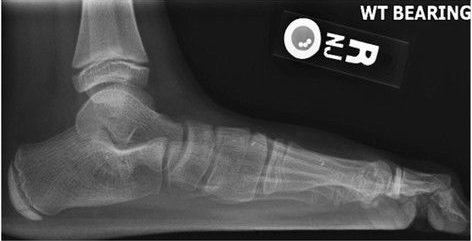 File:Lateral X-ray of a flat foot an C-sign.jpg