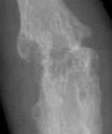 File:X-ray of right fourth PIP joint with bone erosions by rheumatoid arthritis.jpg