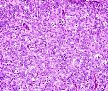 File:Micrograph of prostate cancer with Gleason score 10 (5+5) with solid sheets of cells (crop).jpg