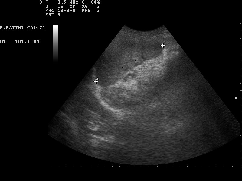 File:Ultrasound image of spleen 110314102702 1031200.jpg