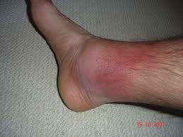File:Erysipeloid skin rashes in Familial Mediterranean Fever.jpg