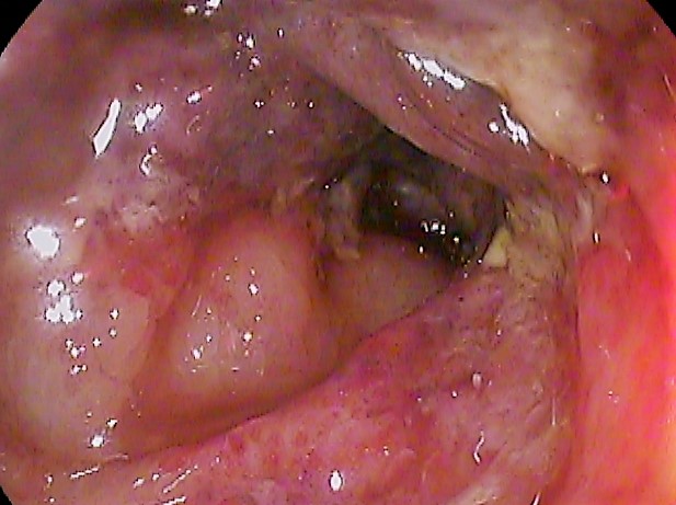 File:Ischemic colitis t-colon.jpg