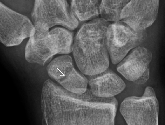 File:Scaphoid fracture with a radiolucent line after 12 days.jpg