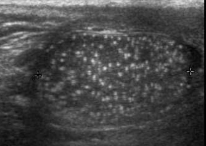 File:Scrotal ultrasonography of testicular microlithiasis.jpg