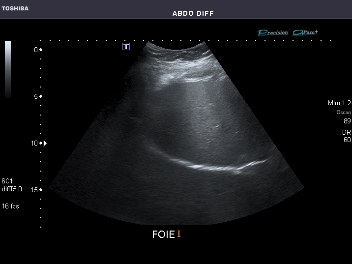 File:Abdominal Ultrasound Full Exam 21.jpg