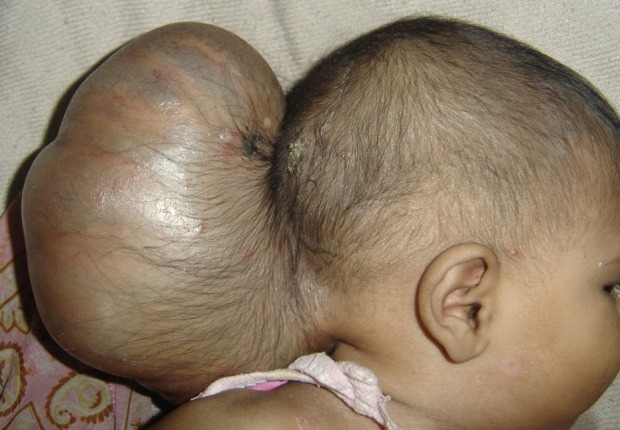 File:A neonate with a large encephalocele.jpg