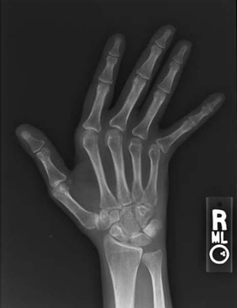 File:Jaccoud arthropathy hand x-ray front.jpg
