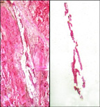 Laser capture microdissection transfer of pure breast duct epithelial cells.jpg