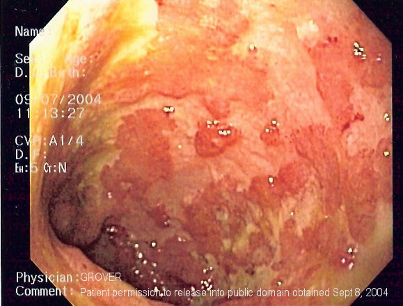 File:Ulcerative colitis.jpg