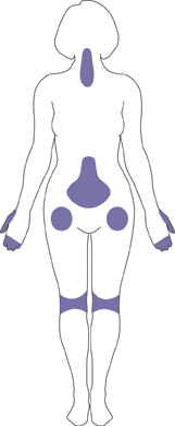 Outline of female body indicating most affected areas