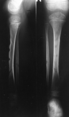 X-ray of the right lower leg of a child with Suarez-Stickler syndrome.png