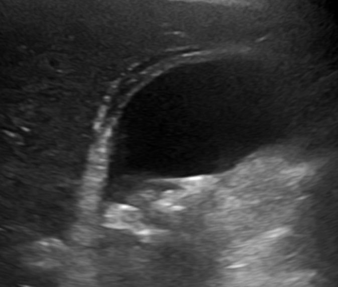 File:Ultrasonography of cholecystitis.jpg