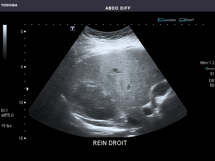 File:Abdominal Ultrasound Full Exam 29.jpg