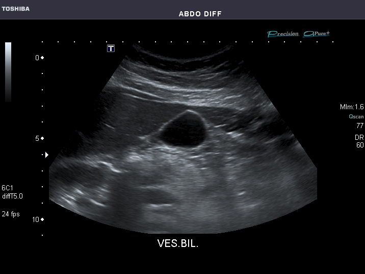 File:Abdominal Ultrasound Full Exam 16.jpg
