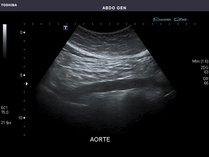 File:Abdominal Ultrasound Full Exam 45.jpg
