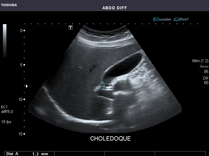 File:Abdominal Ultrasound Full Exam 12.jpg