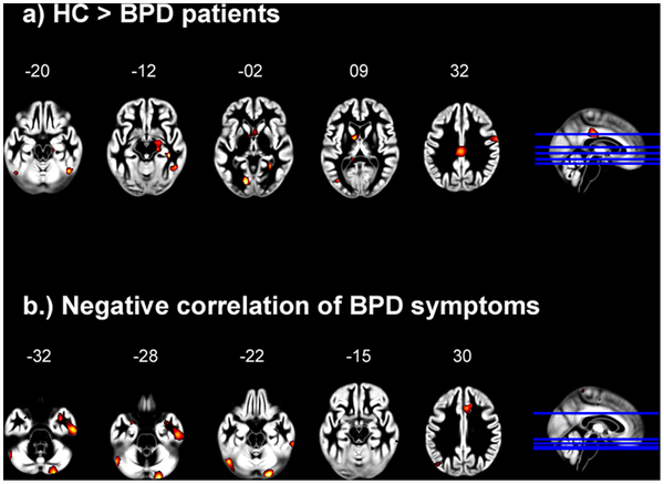 File:Figure 1 of Voxel-Based Morphometry in Women with Borderline Personality Disorder with and without Comorbid Posttraumatic Stress Disorder.png