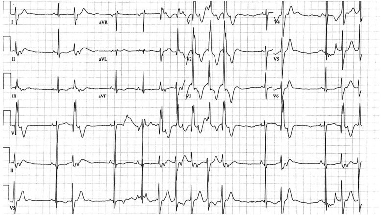 File:PMC6177042 Nguyen 2018 Bidirectional ventricular tachycardia in Andersen-Tawil syndrome.jpg