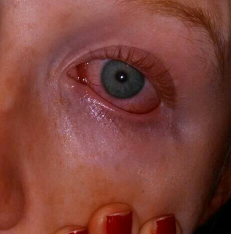 File:Actinic conjunctivitis causes a redness of the eyes, as well as swelling and often grayness around the eyes- 2014-05-21 23-27.JPG