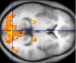Monochrome fMRI image of a horizontal cross-section of a human brain. A few regions, mostly to the rear, are highlighted in orange and yellow.