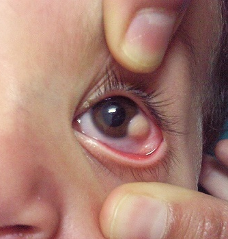 File:Goldenhar syndrome limbal dermoid.png