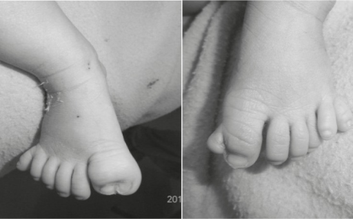 File:Polydactyly in a 1 day old infant due acrocallosal syndrome.png