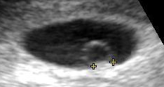 Ultrasound of embryo at 5 weeks.png