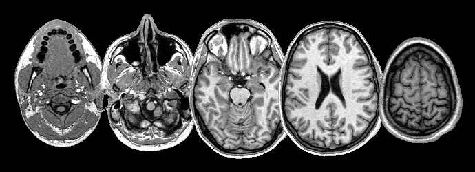 File:MRI Head 5 slices.jpg