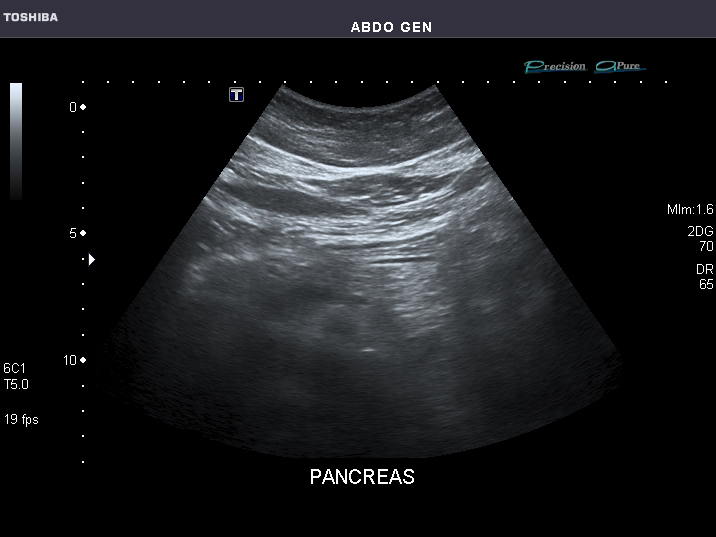 File:Abdominal Ultrasound Full Exam 40.jpg